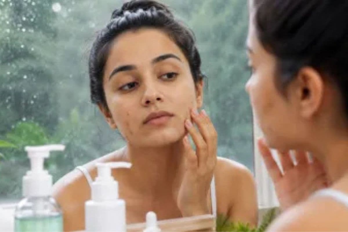 Monsoon Acne Skincare Tips: मानसून में एक्ने से है परेशान तो अपनाएं ये स्किनकेयर टिप्स